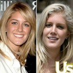 heidi montag post surgery2 141