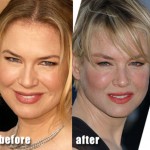 renee zellweger plastic surgery