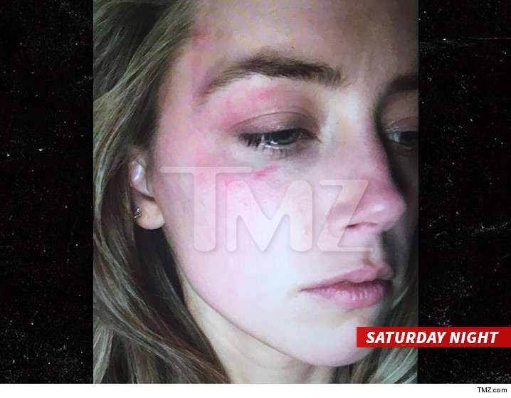 amber heard injury tmz