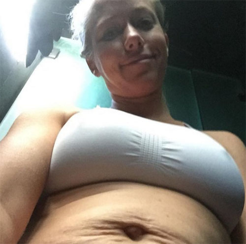 kendra wilkinson flacida estrias