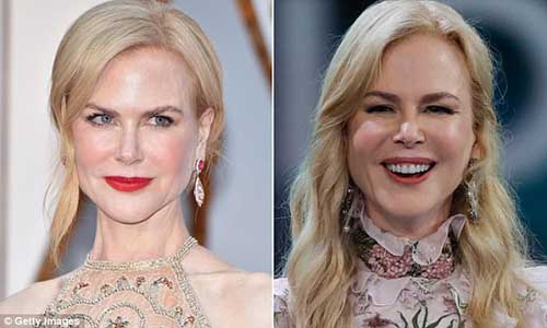 nicole kidman face before after