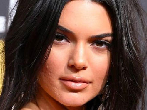 kendall Jenner acne