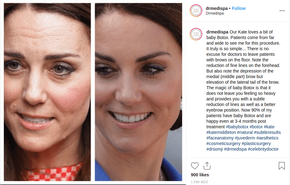 Kate Middleton se inyectó Botox?