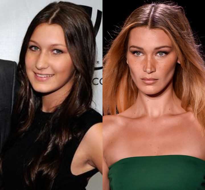 bella hadid before and after plastic surgery