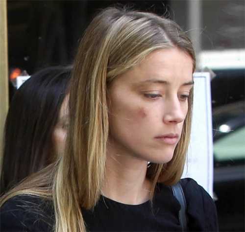 amber heard moretones corte