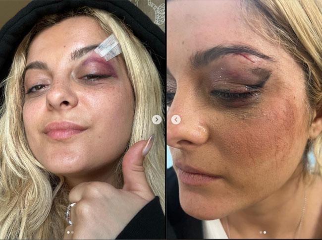 Bebe Rexha herida en el ojo - ceja