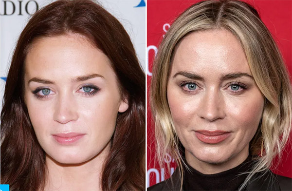 emily blunt plastic surgery