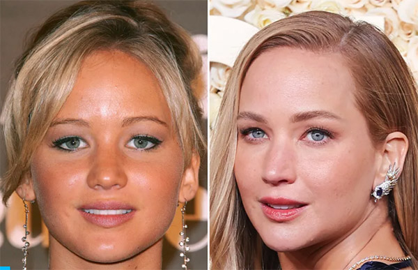 jennifer lawrence plastic surgery