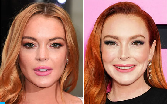 lindsay lohan plastic surgery