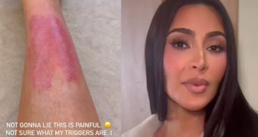 Kim Kardashian comparte su brote de psoriasis