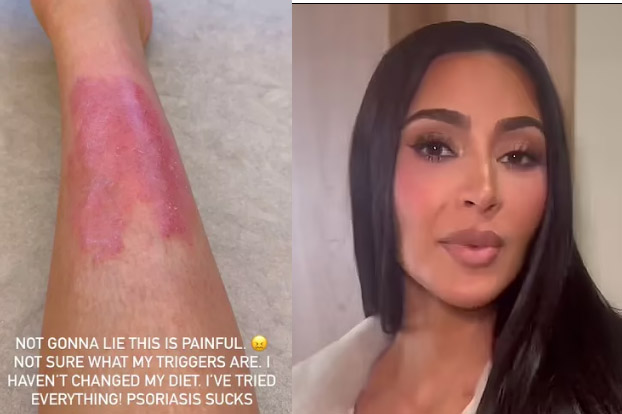 Kim Kardashian comparte su brote de psoriasis