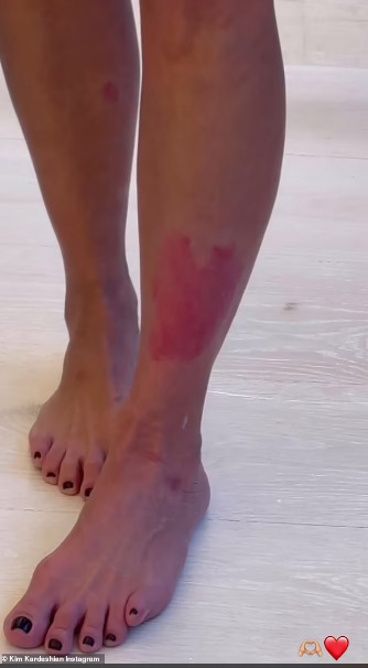 kim kardashian psoriasis pierna izquierda video