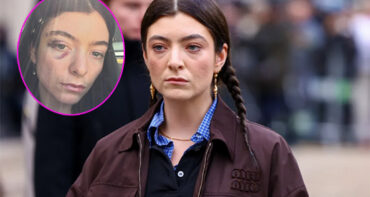 Lorde y su ojo morado preocupa a los fans
