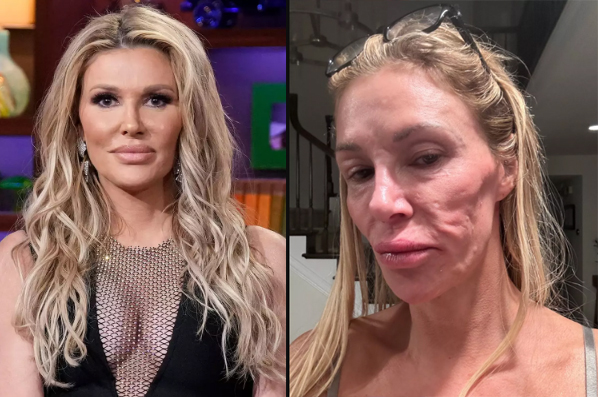 Brandi Glanville tiene la cara desfigurada por un parásito