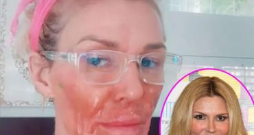Brandi Glanville quemó su rostro intentando matar al parásito