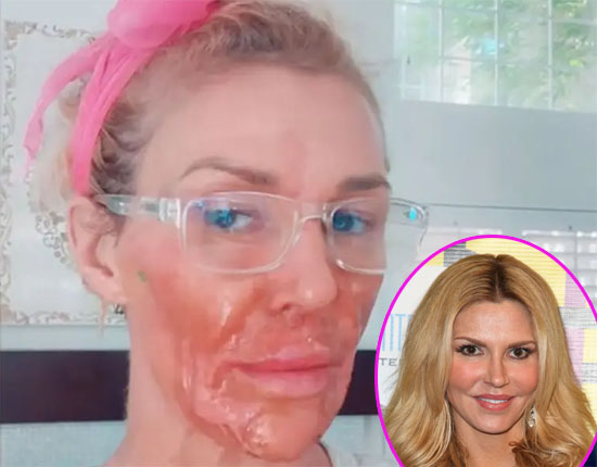 Brandi Glanville quemó su rostro intentando matar al parásito