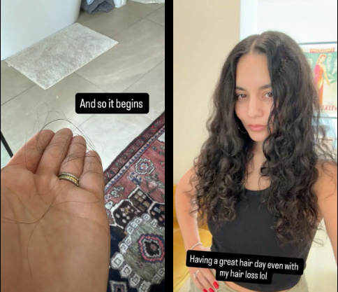 Vanessa Hudgens perdiendo el cabello